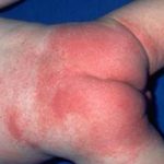 Аллергия у ребенка на попе