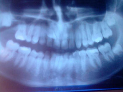 rentgen-zuba-pri-beremennosti