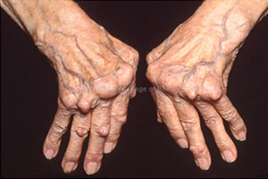 revmatoidnyj-artrit