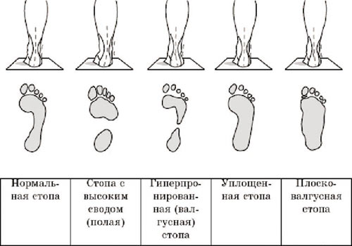 stadii-razvitiya-ploskostopiya