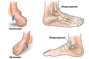 Лечение в домашних условиях растяжения связок голеностопного сустава